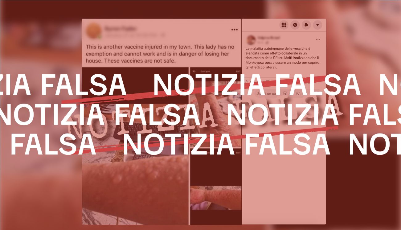 No, il vaiolo delle scimmie non è «un modo per coprire gli effetti collaterali» del vaccino Pfizer